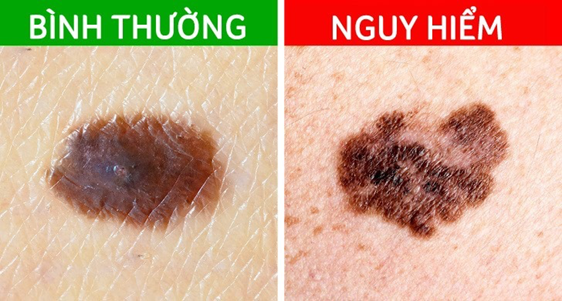 Nên tẩy nốt ruồi trên da hay không?