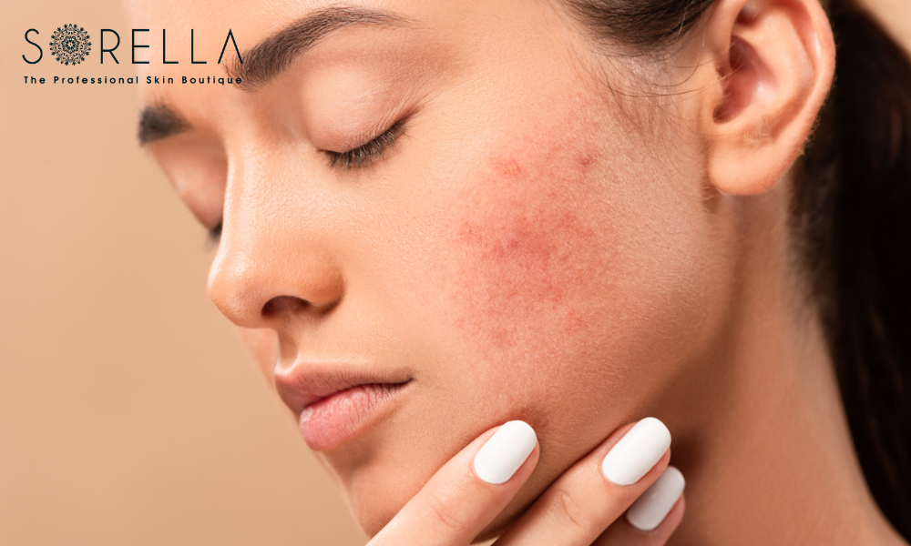 Retinoids make your skin more sensitive to the sun, cause dry skin and redness