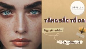 tăng sắc tố da