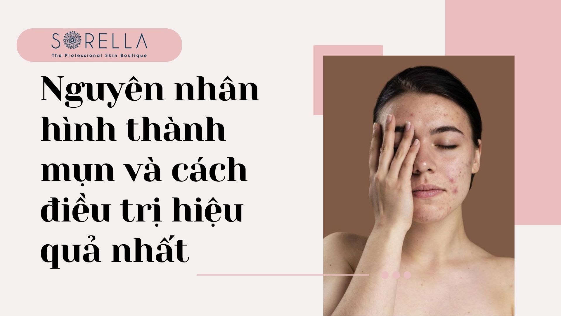 Nguyên nhân hình thành mụn và cáh điều trị hiệu quả nhất