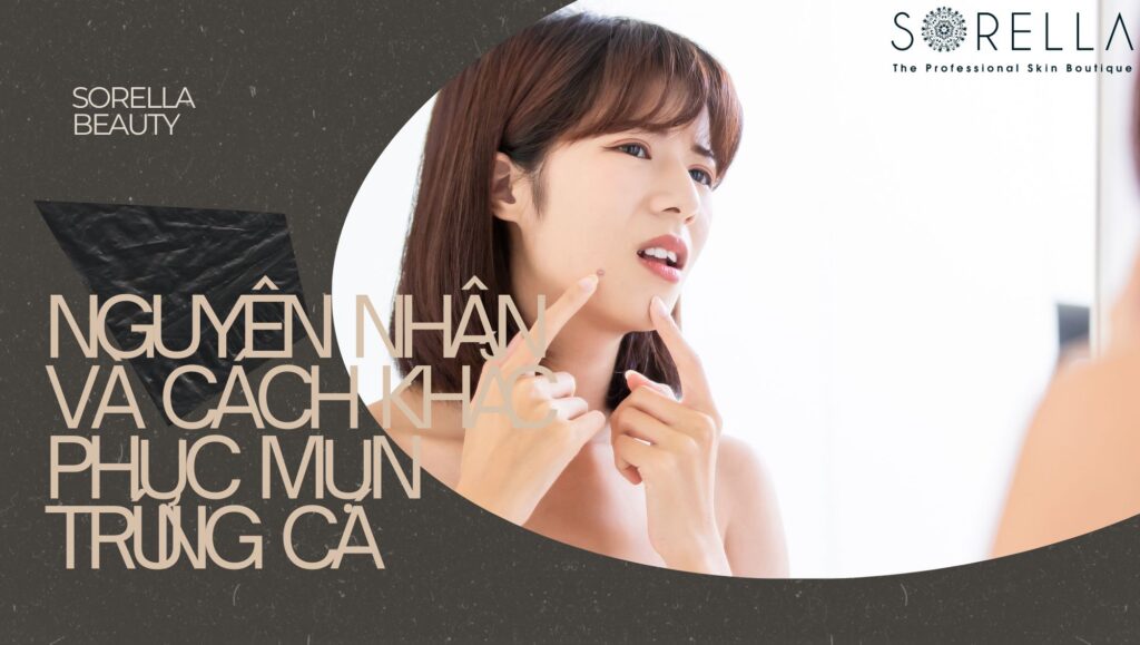 mụn trứng cá