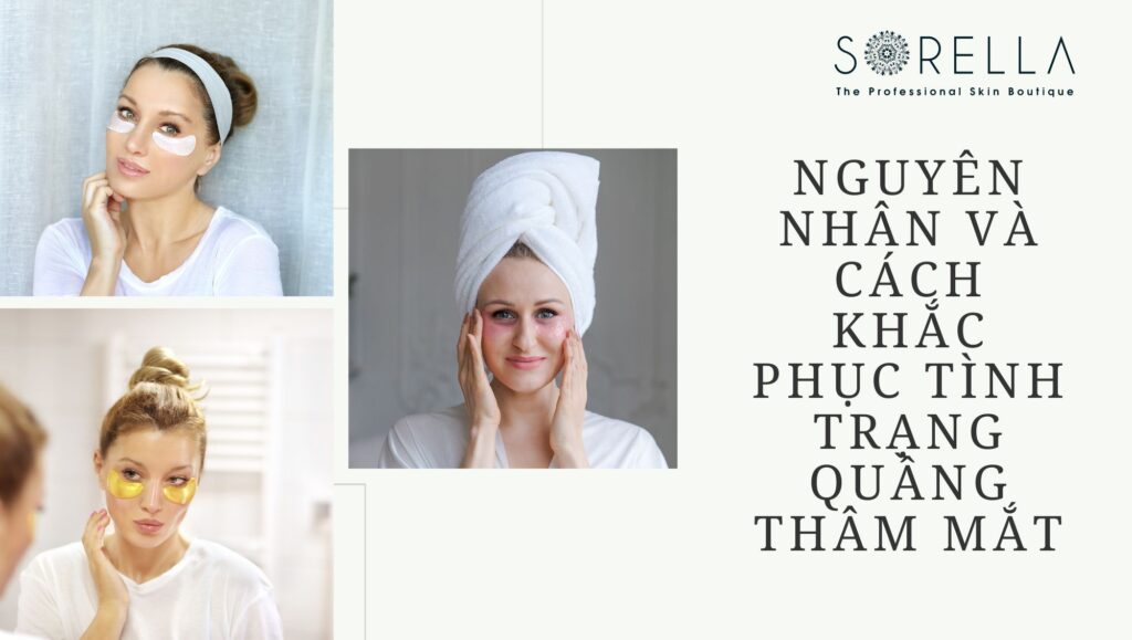 quầng thâm mắt