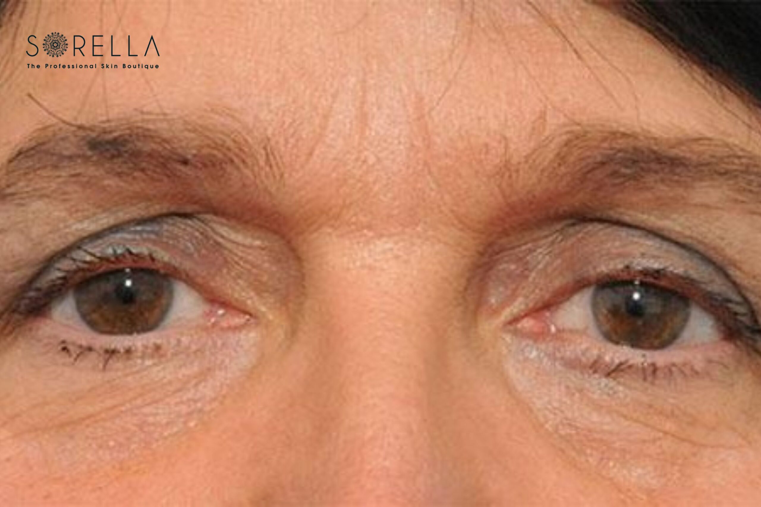 Lão hóa là nguyên nhân khá phổ biến gây ra sụp mí mắt 