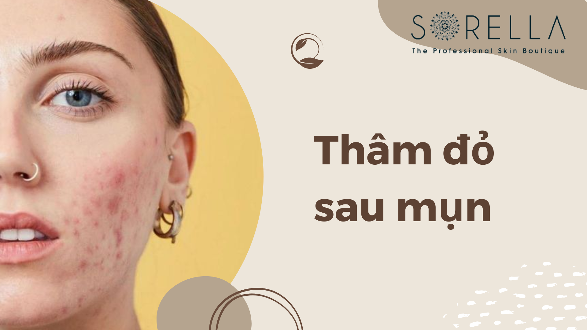 Thâm đỏ sau mụn