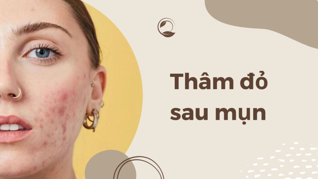 Thâm đỏ sau mụn