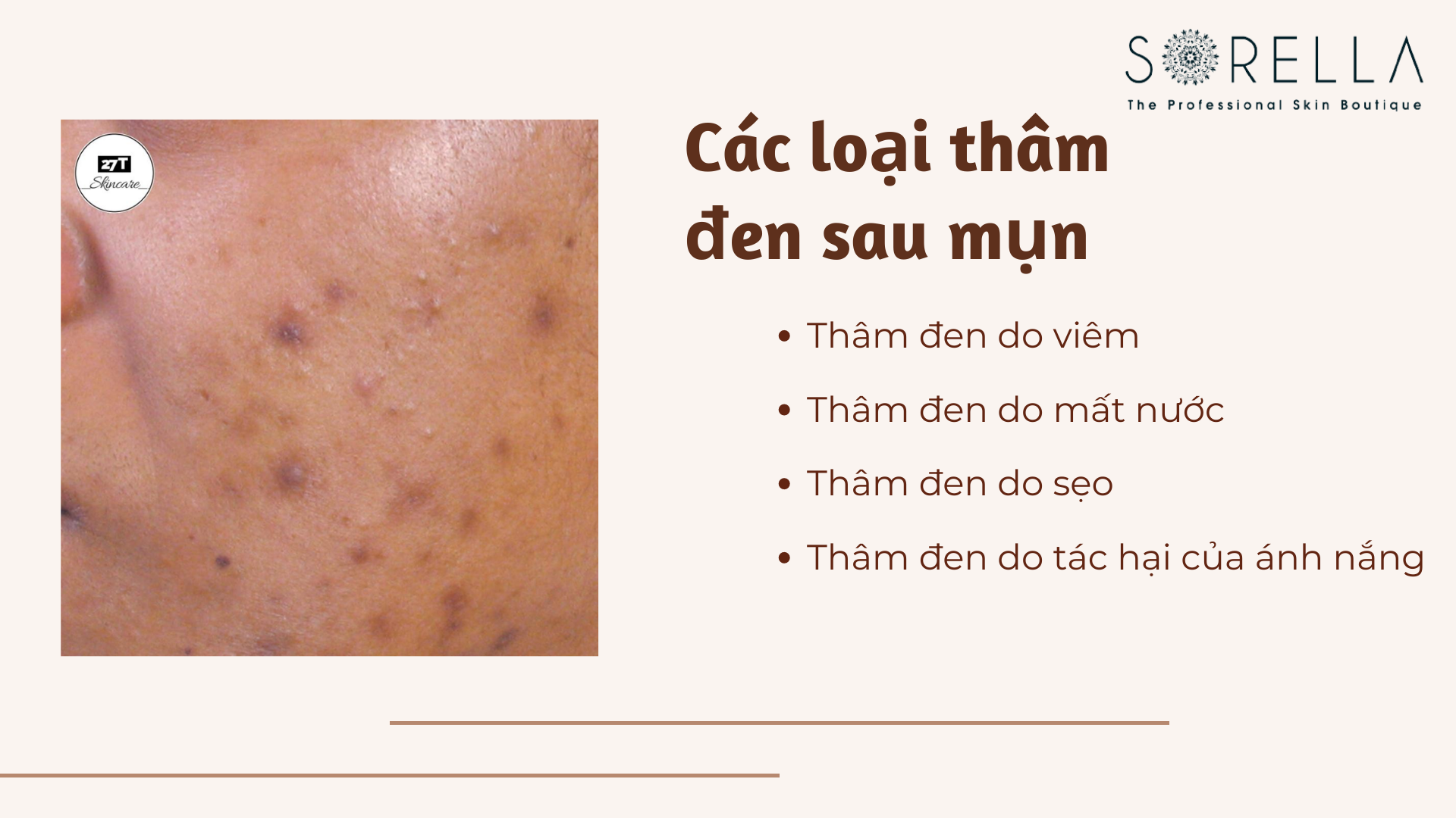 Các loại thâm đen sau mụn