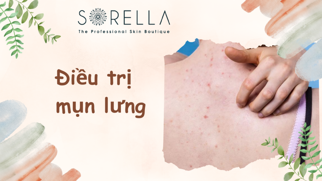 Điều trị mụn lưng