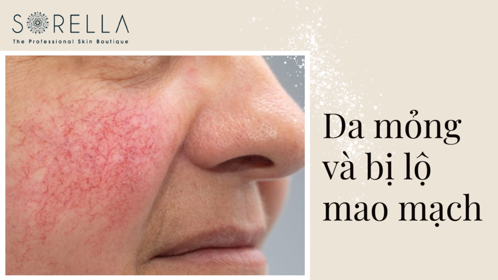 Da mỏng và bị lộ mao mạch