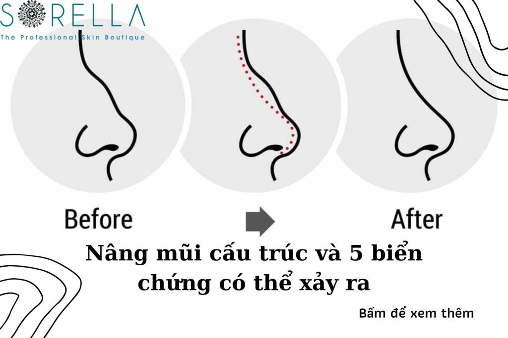 nâng mũi cấu trúc có an toàn không