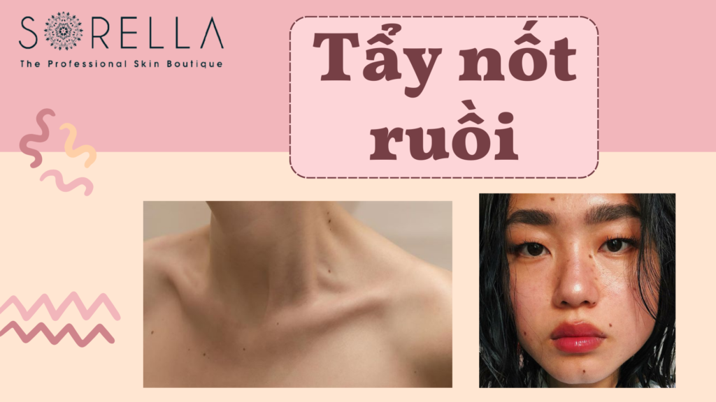 Tẩy nốt ruồi
