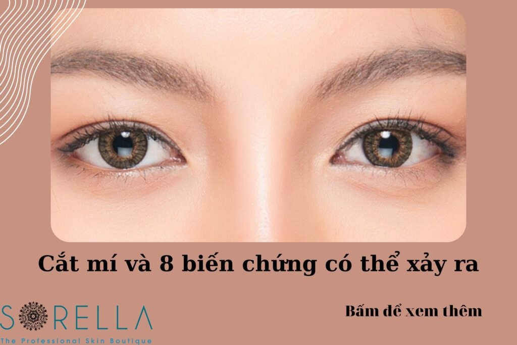 cắt mí