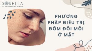 Phương pháp điều trị đốm đồi mồi ở mặt