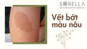 Vết bớt màu nâu