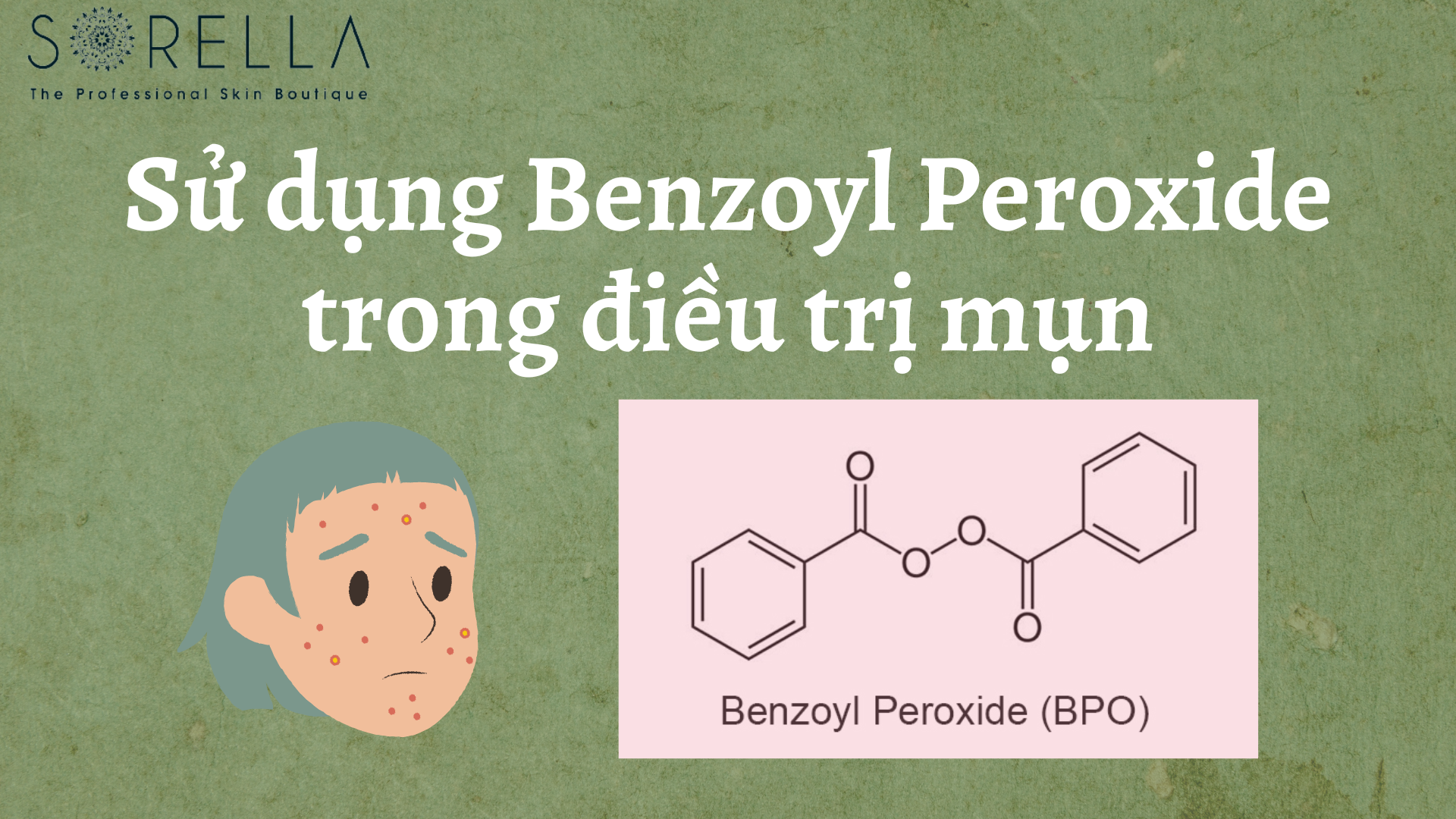 Sử dụng Benzoyl Peroxide trong điều trị mụn