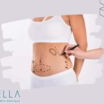 https://sorellabeautyspa.com/hut-mo-bung-va-6-dieu-can-luu-y.html hút mỡ bụng