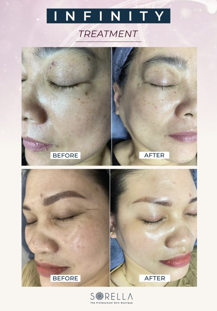 Infinity Treatment at Sorella