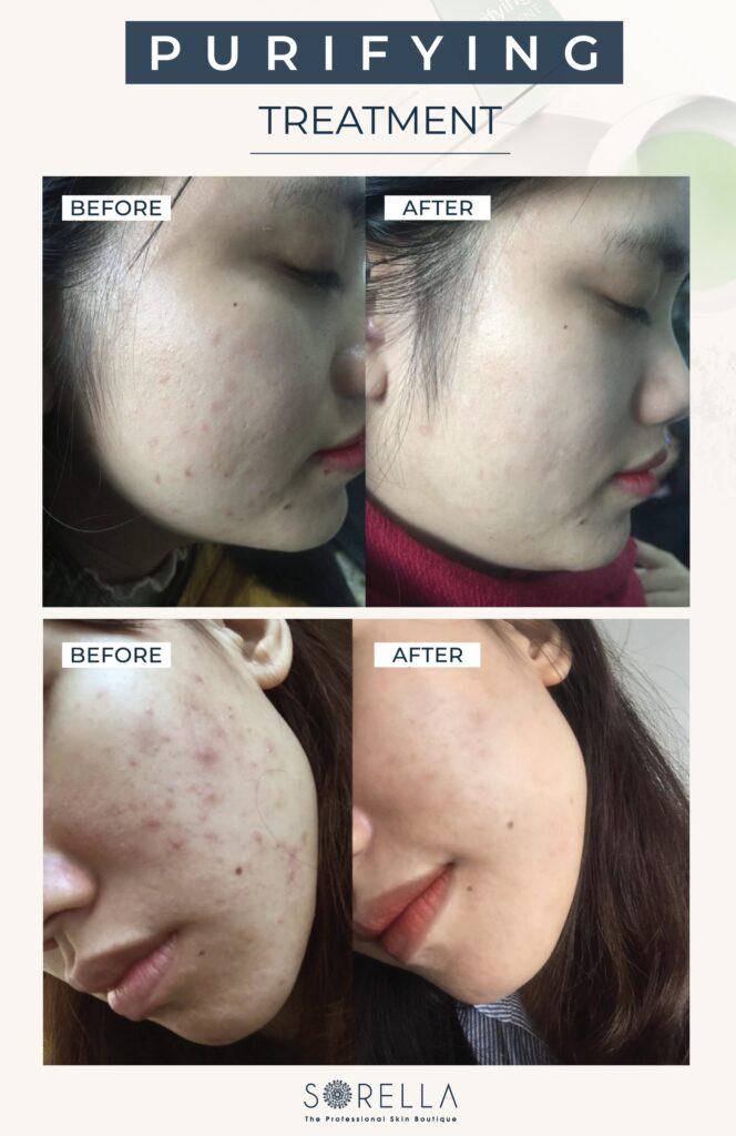Purifying Treatment tại Sorella