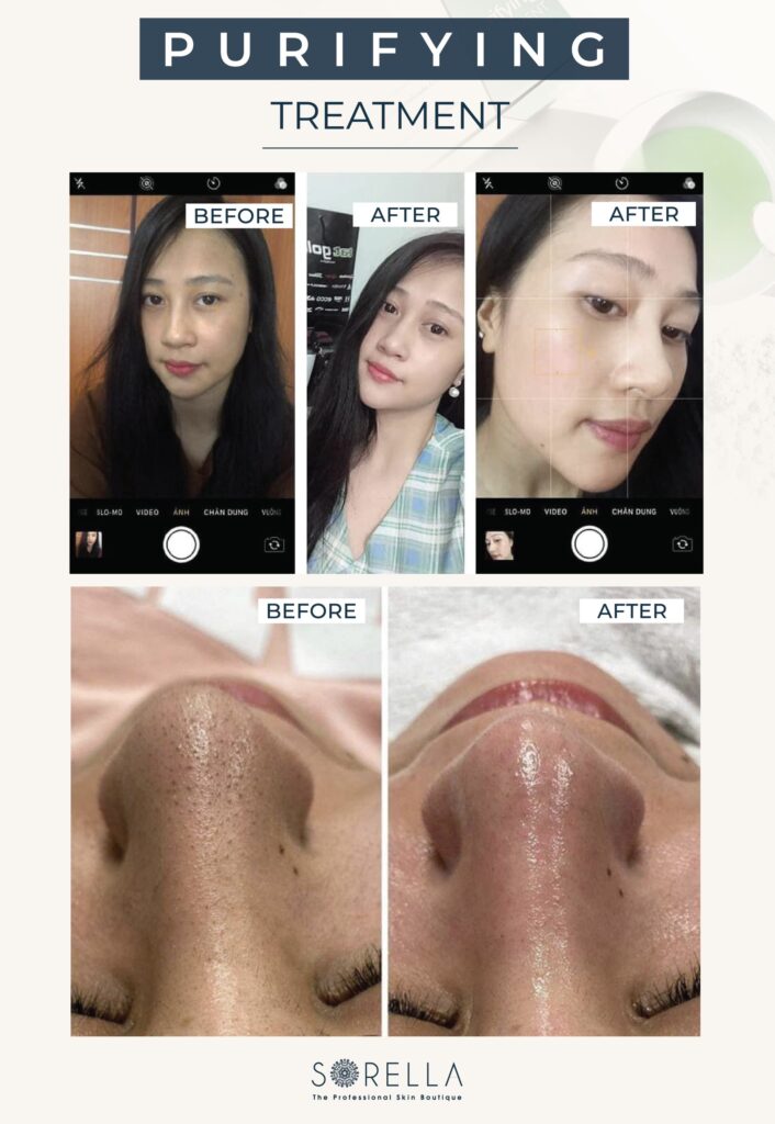 Purifying Treatment tại Sorella