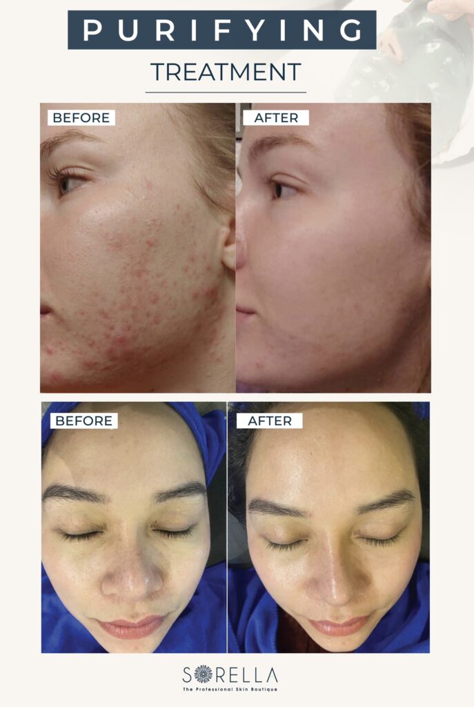 Purifying Treatment tại Sorella