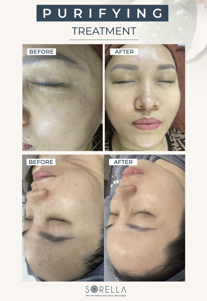 Purifying Treatment tại Sorella