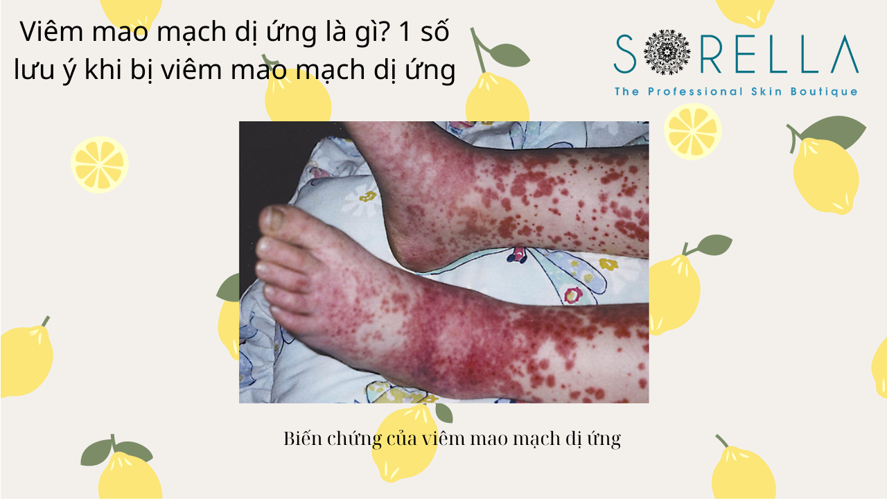 VIêm mao mạch dị ứng là gì?