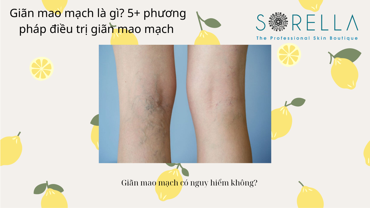 GIãn mao mạch là gì?