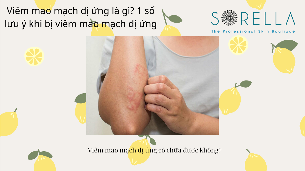 VIêm mao mạch dị ứng là gì?