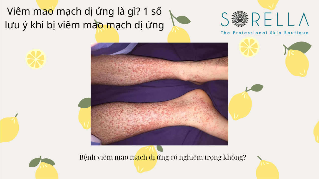 VIêm mao mạch dị ứng là gì?