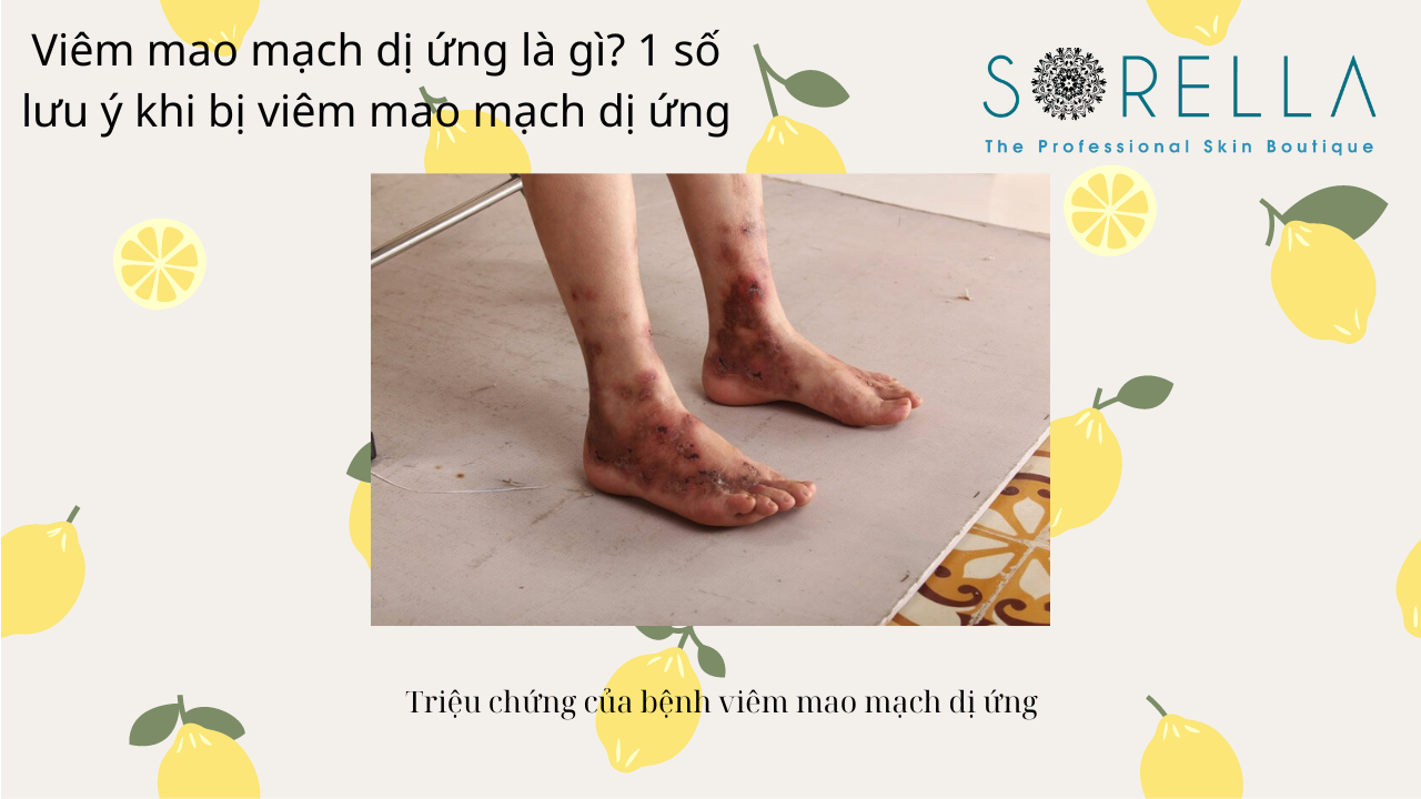 VIêm mao mạch dị ứng là gì?