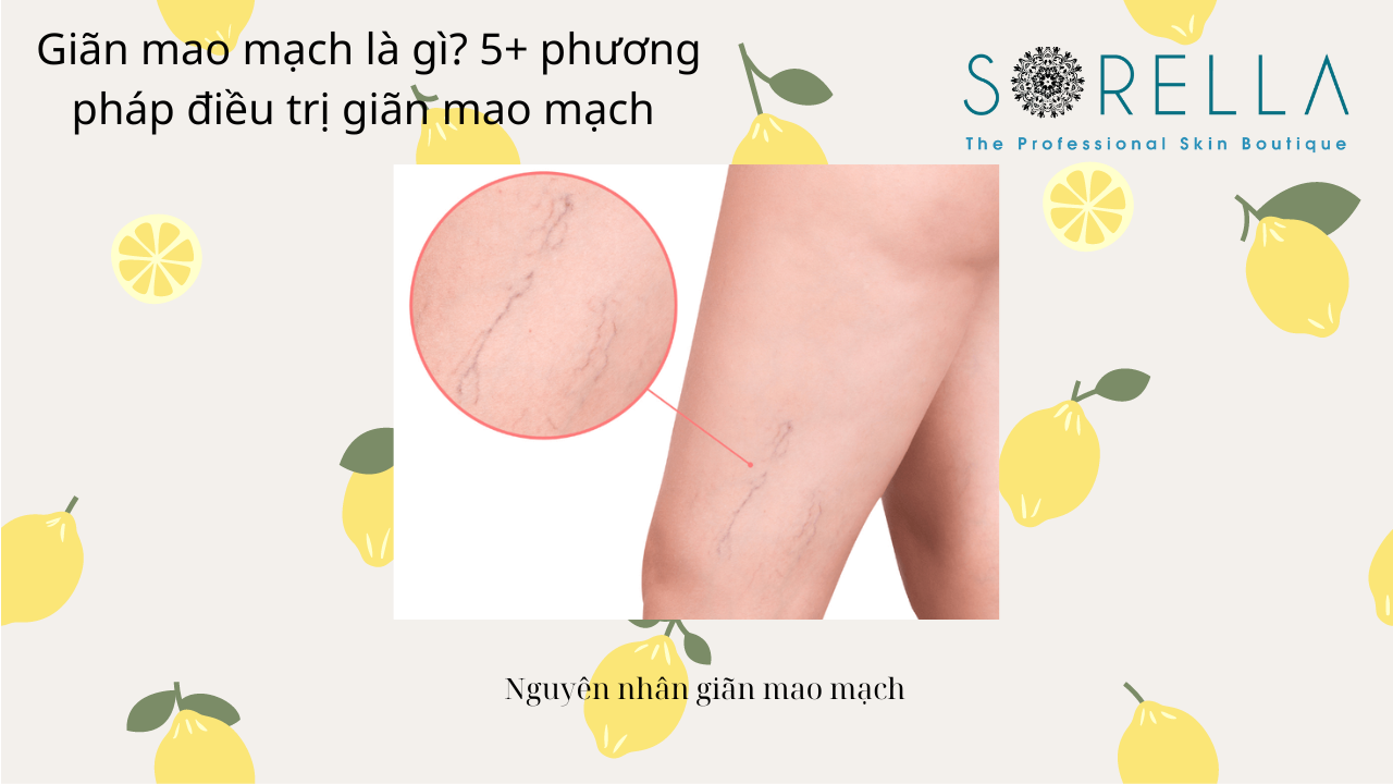 GIãn mao mạch là gì?