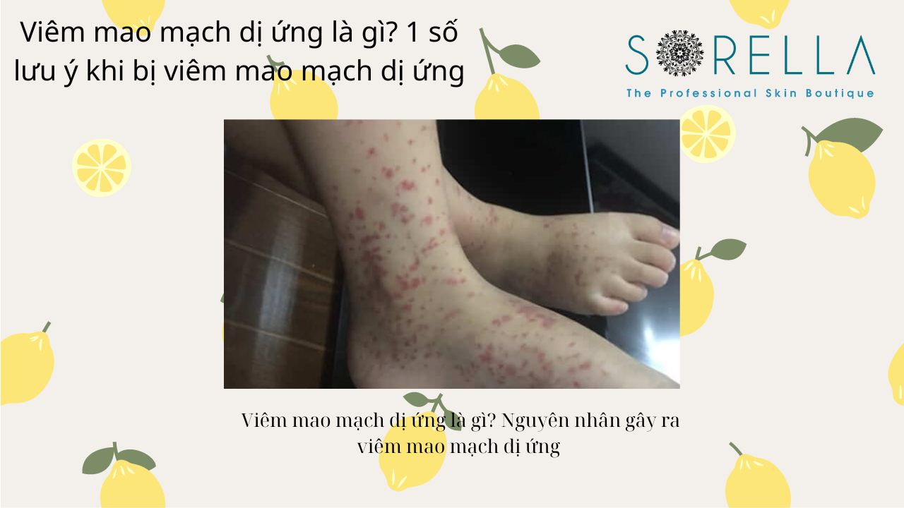 VIêm mao mạch dị ứng là gì?