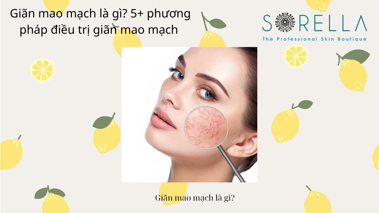 GIãn mao mạch là gì?