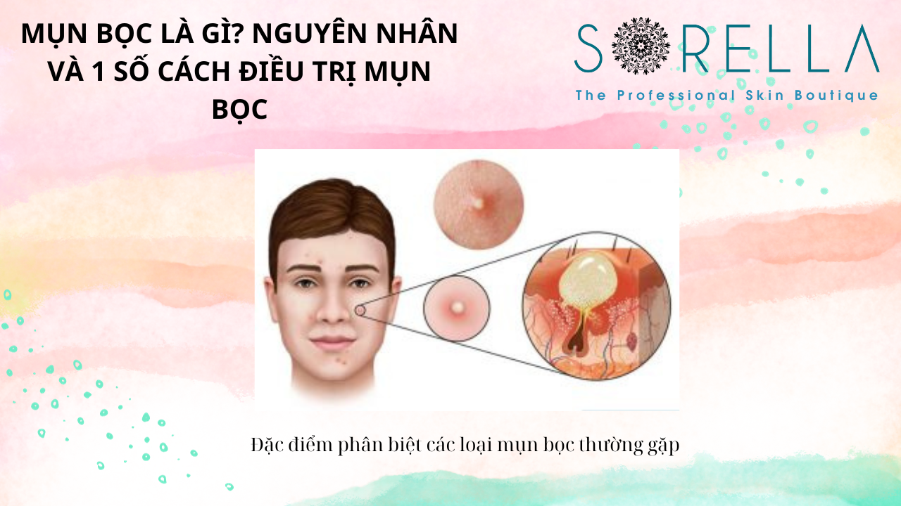 Mụn bọc là gì?