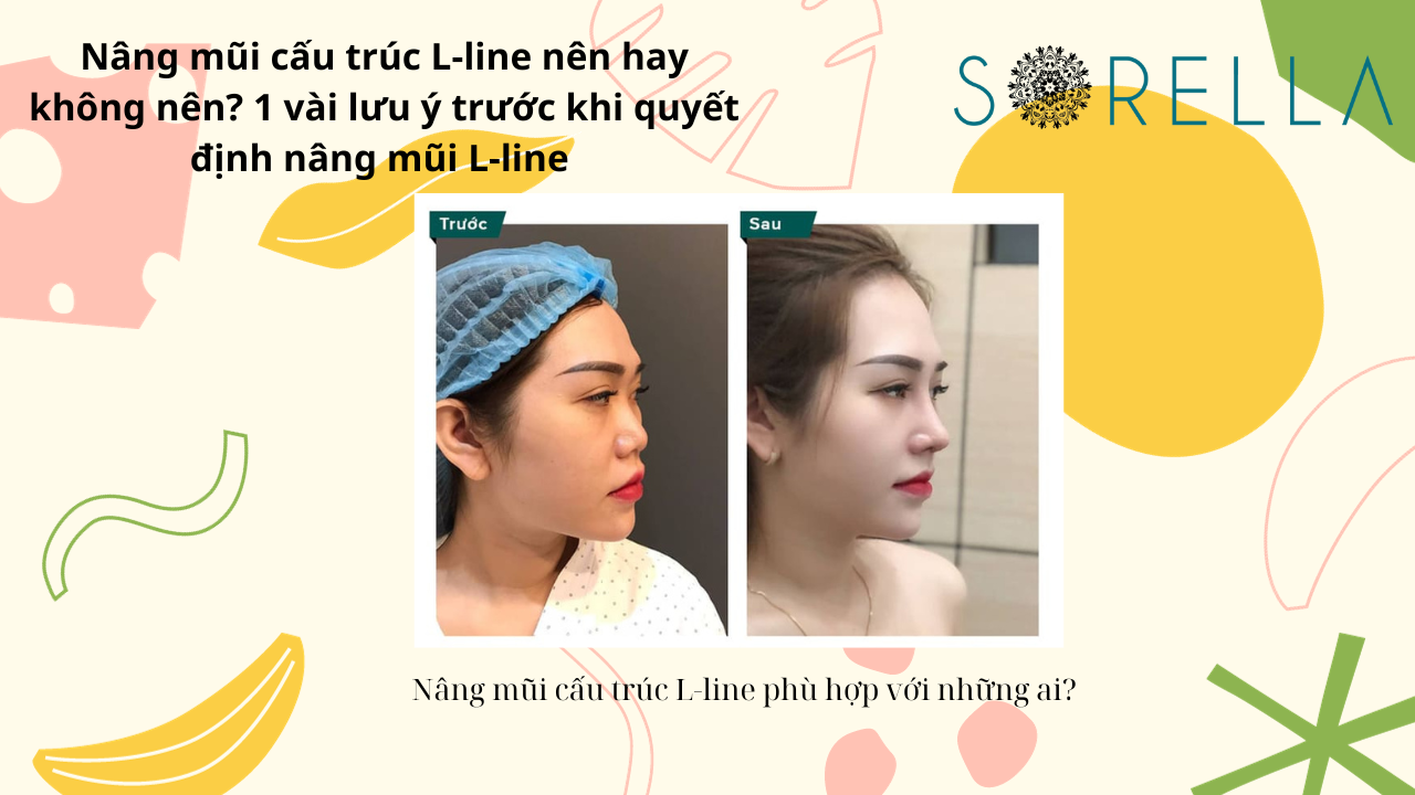 Nâng mũi cấu trúc L-line 