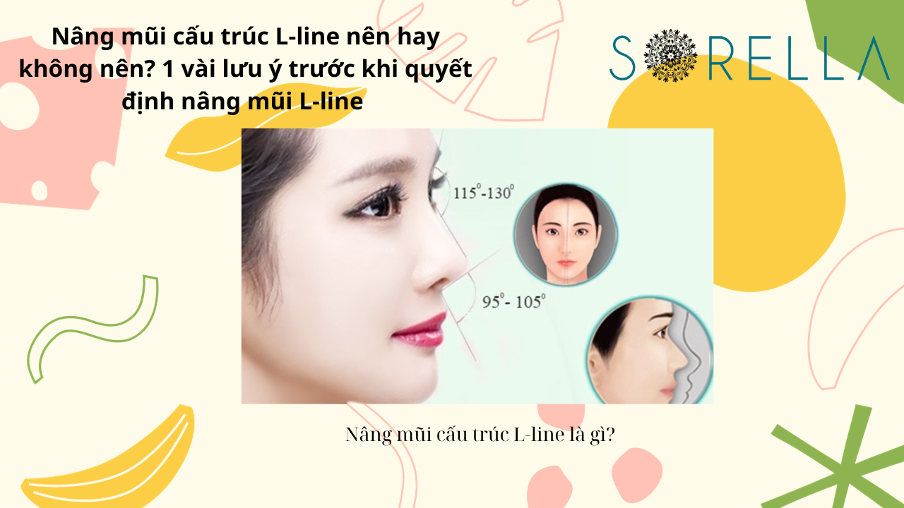 Nâng mũi cấu trúc L-line 