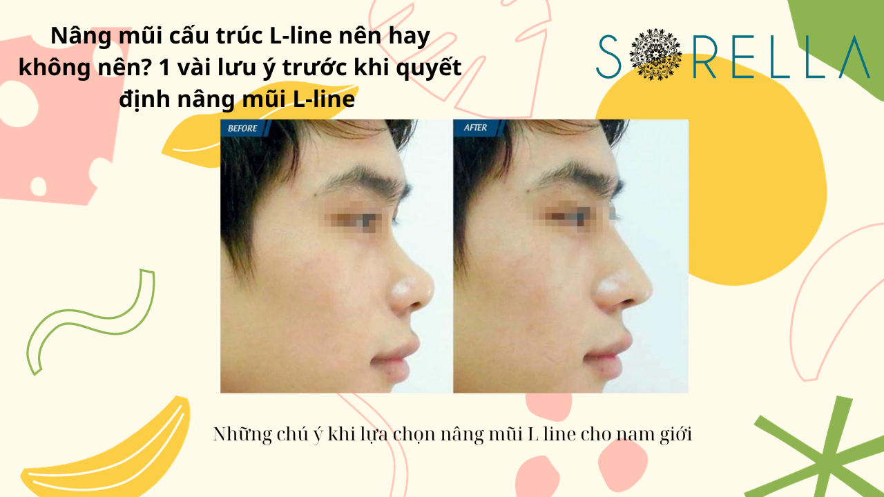 Nâng mũi cấu trúc L-line 