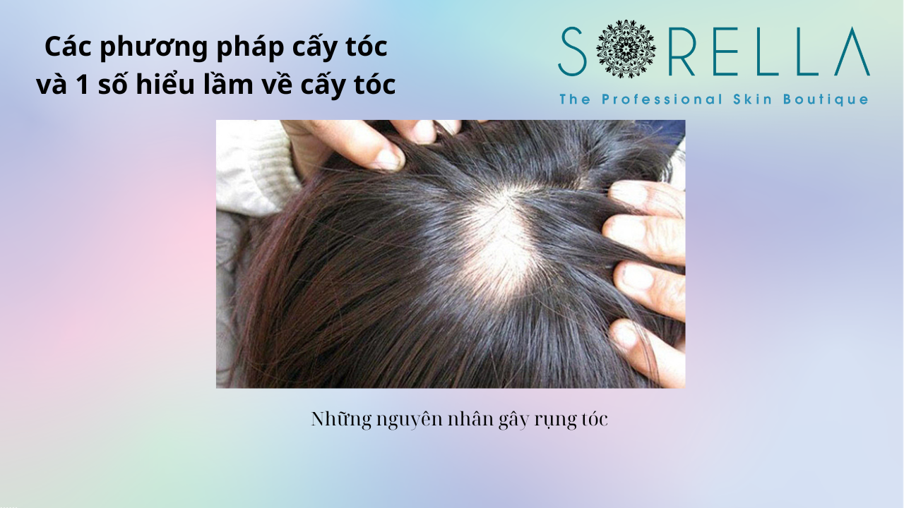 Các phương pháp cấy tóc