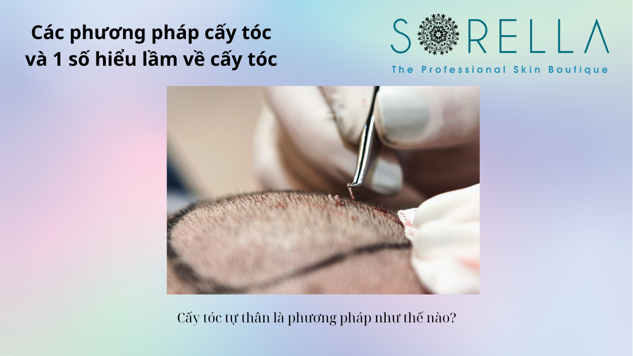 Các phương pháp cấy tóc 