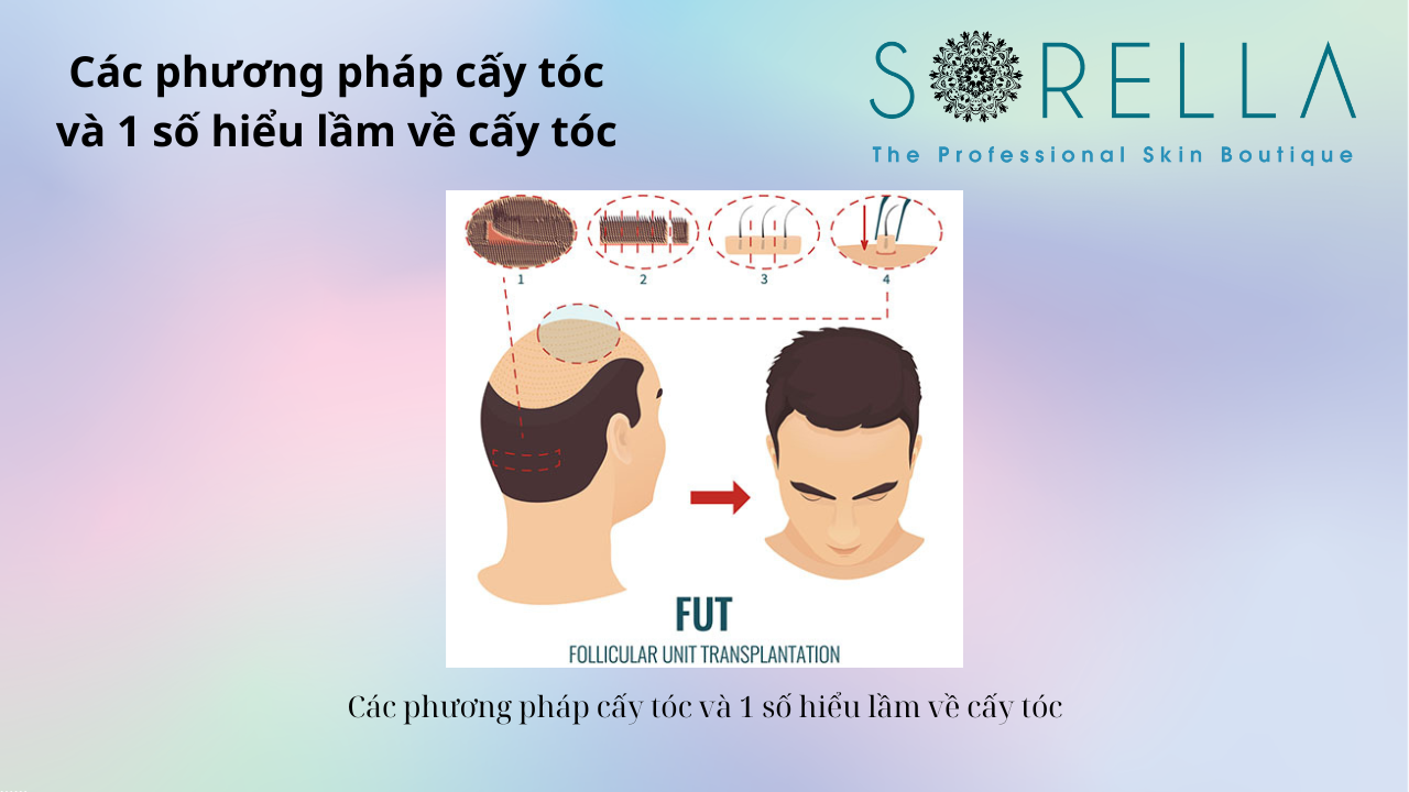 Các phương pháp cấy tóc