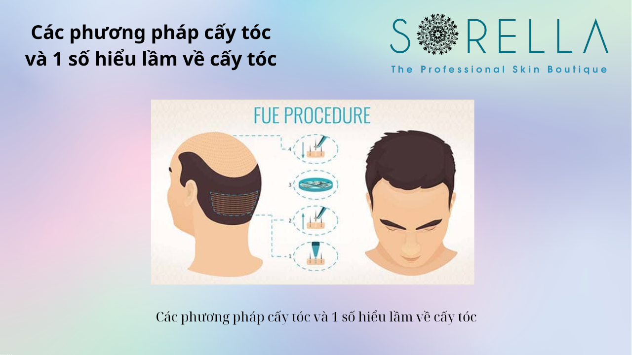 Các phương pháp cấy tóc 