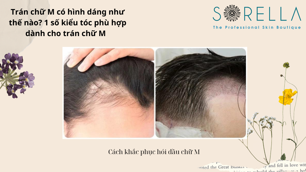 Trán chữ M có hình dáng như thế nào? 