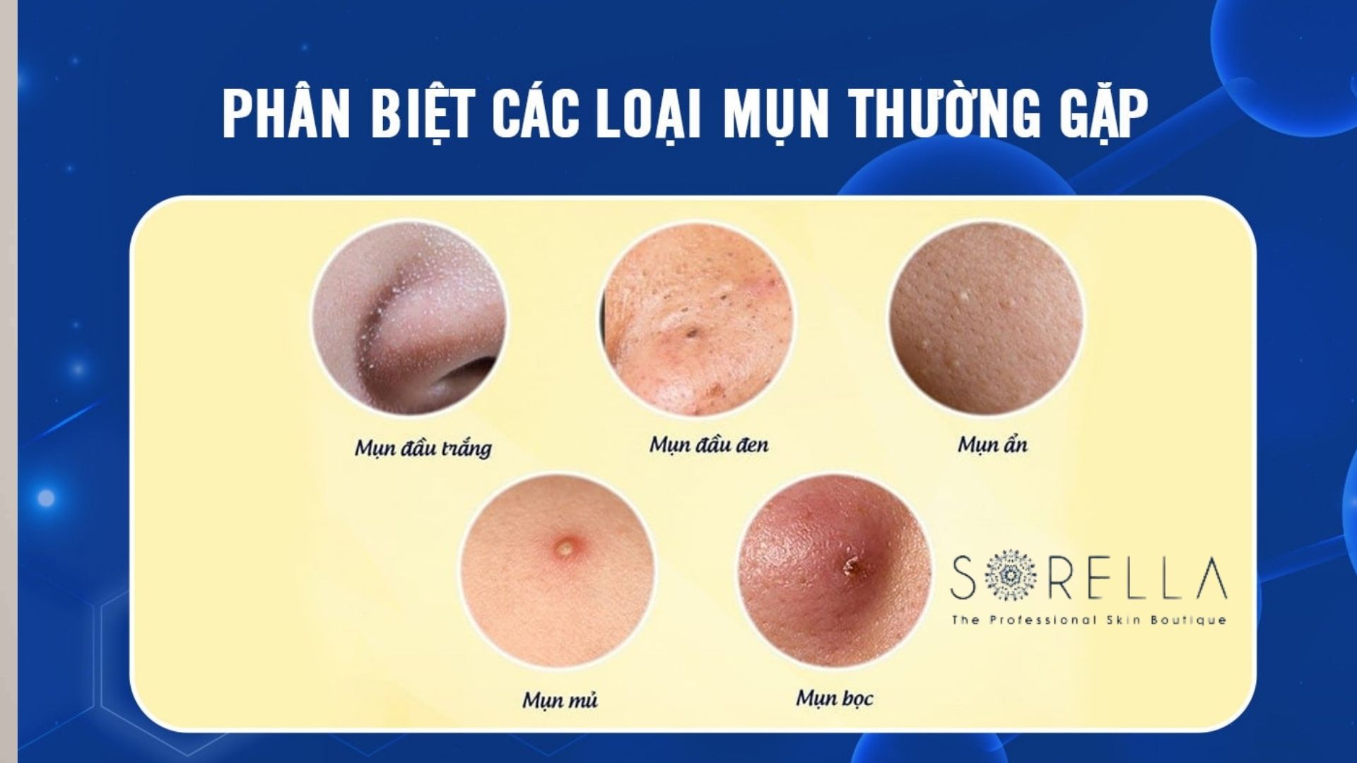 8 Nguyên nhân gây mụn và cách điều trị