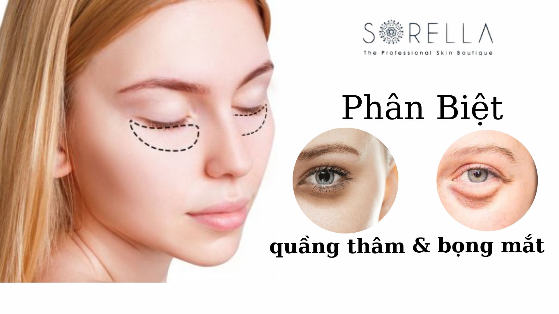 Phân biệt quầng thâm và bọng mắt - 9 cách điều trị tại nhà hiệu quả