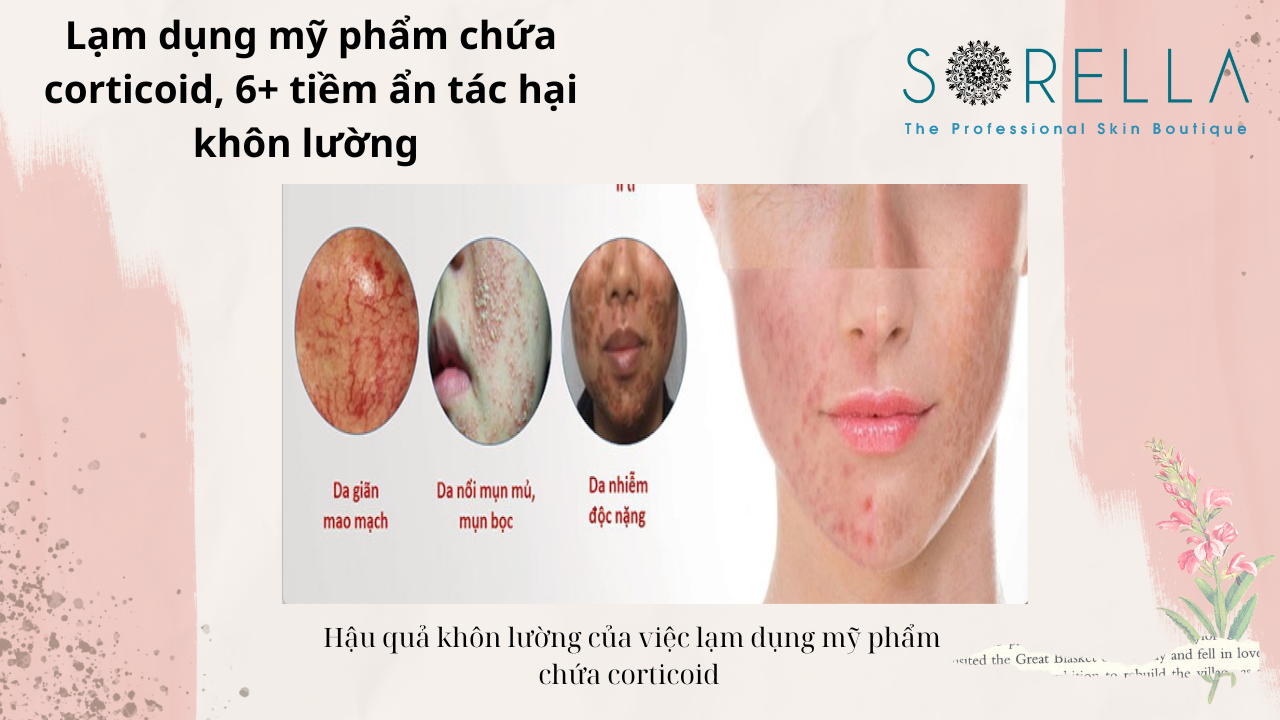 Lạm dụng mỹ phẩm chứa corticoid 