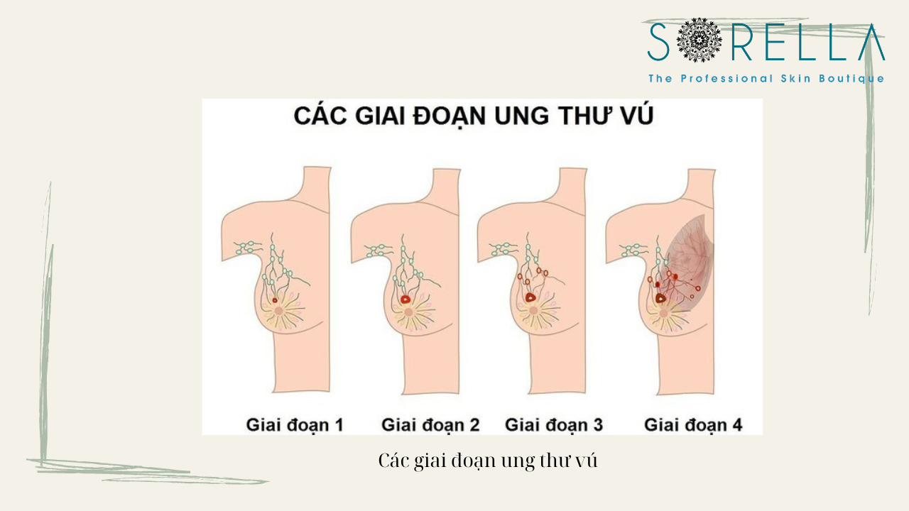 Ung thư vú sẽ như thế nào?