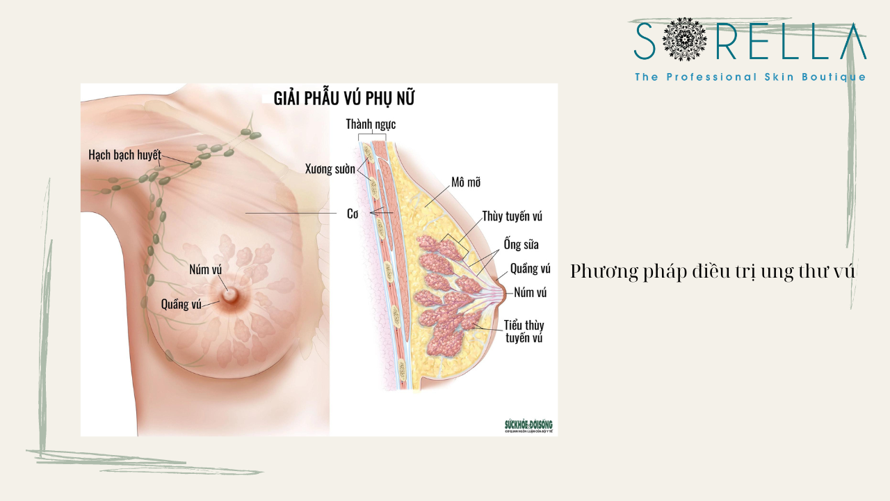 Ung thư vú sẽ như thế nào?