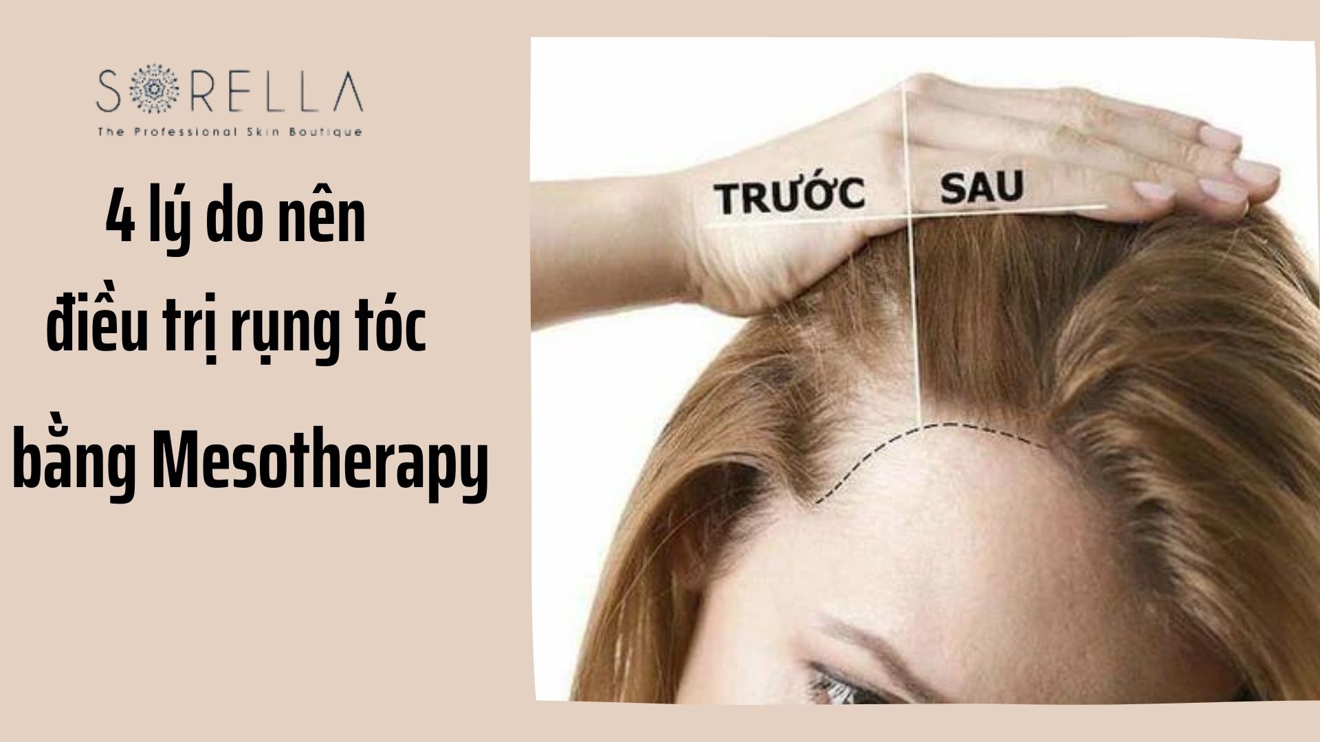 4 lý do nên tiêm meso điều trị rụng tóc