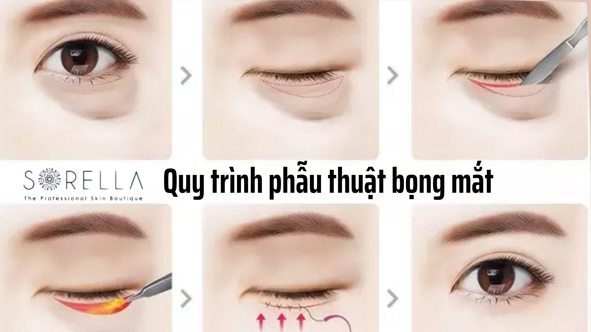 4 điều cần biết về phẫu thuật bọng mắt