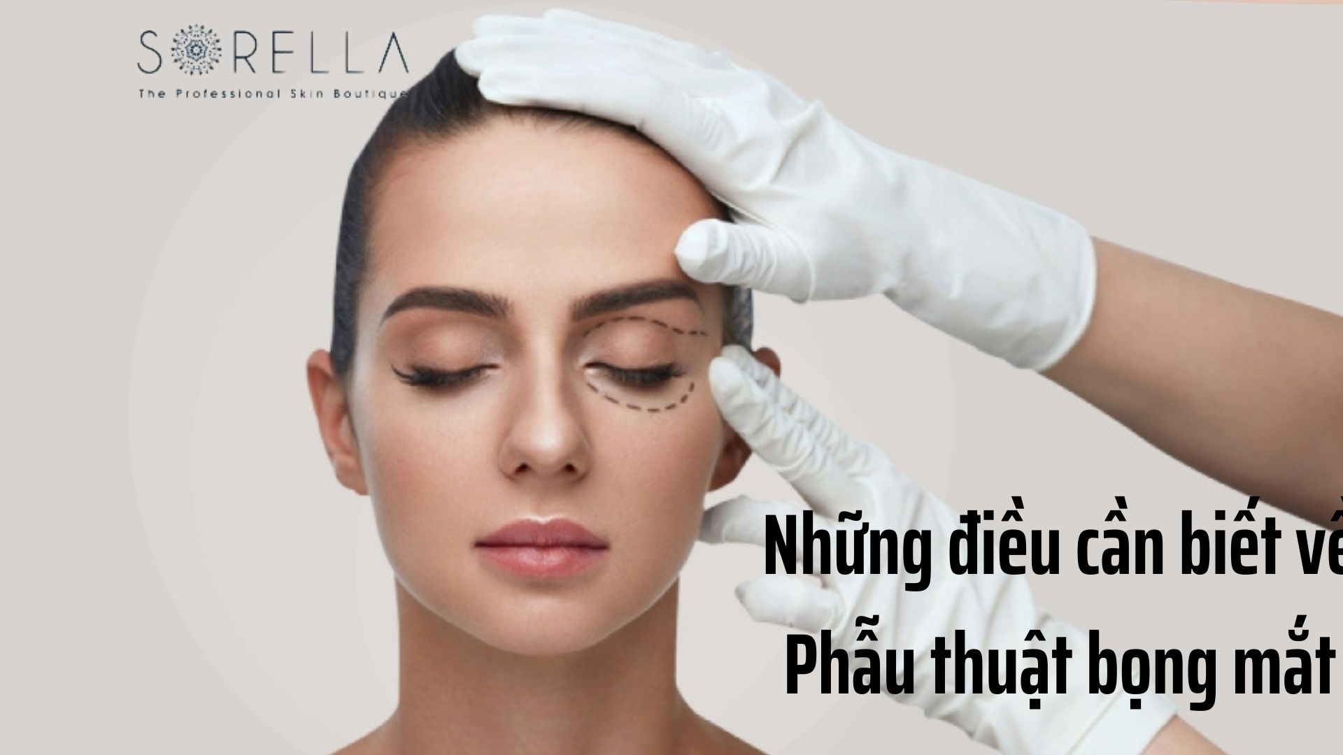 4 điều cần biết về phẫu thuật bọng mắt