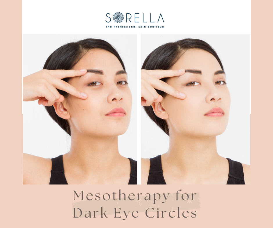 How Does Mesotherapy for Dark Eye Circles Work?